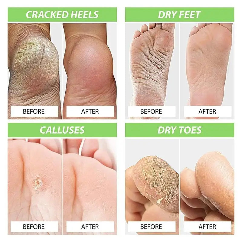 Before and after images showing effects of natural foot balm for dry skin on cracked heels, dry feet, calluses, and dry toes